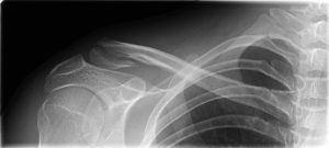 Shoulder Pain, Shoulder Injuries, Clavicle Fracture